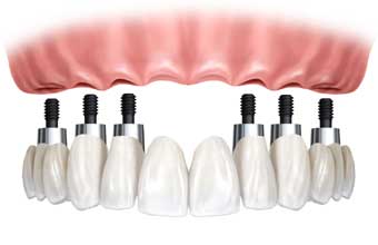 Odonto Prótese Sorriso - Foto 1